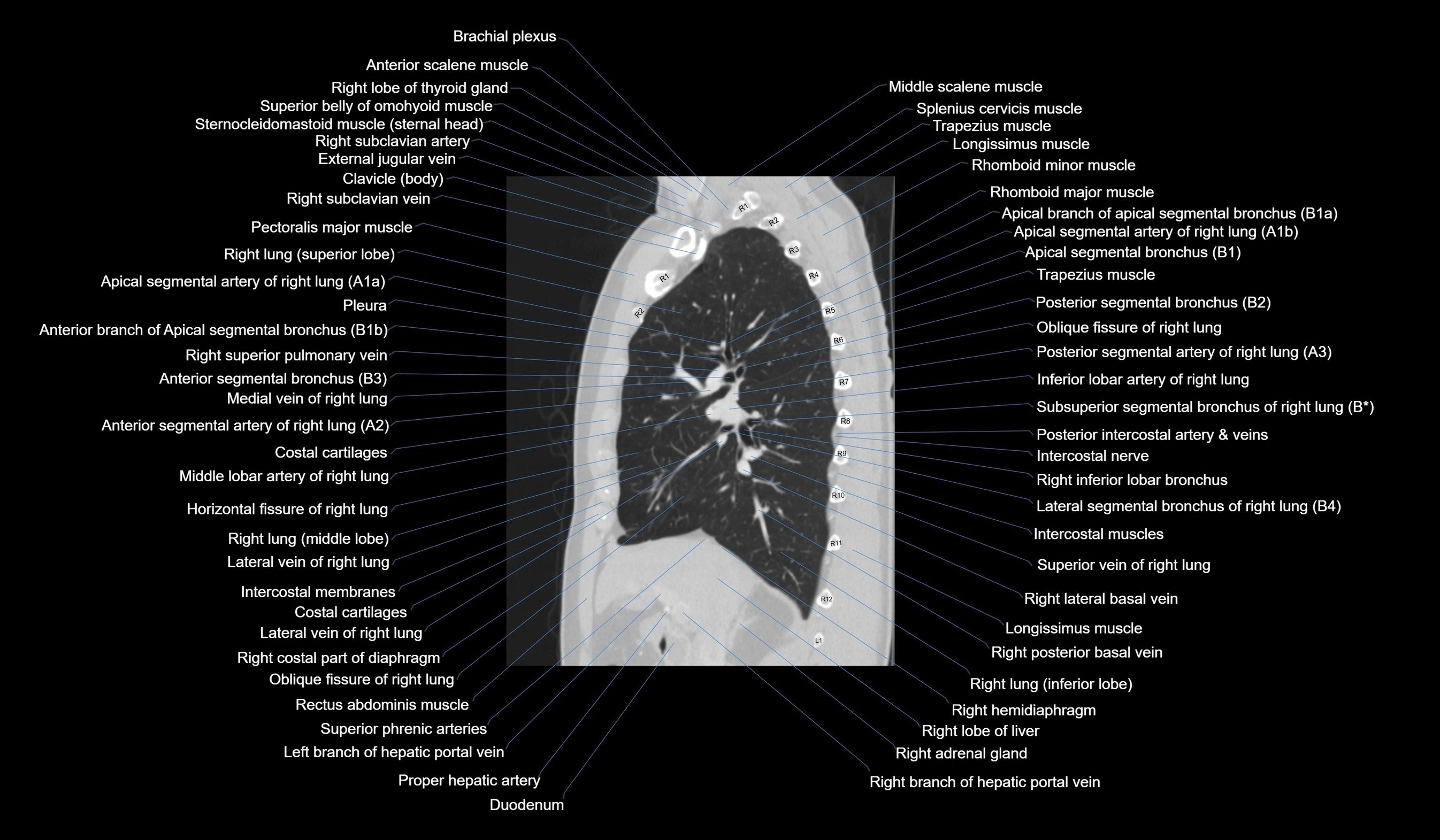 CT chest (thorax) lung window labelled sagittal cross sectional anatomy radiology image-00058.webp